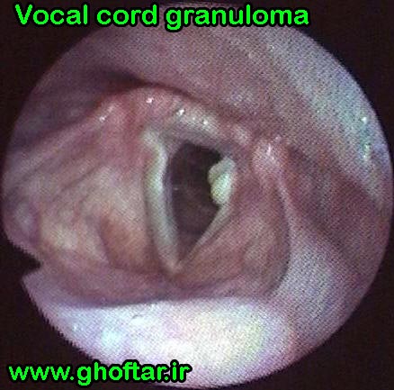 granuloma